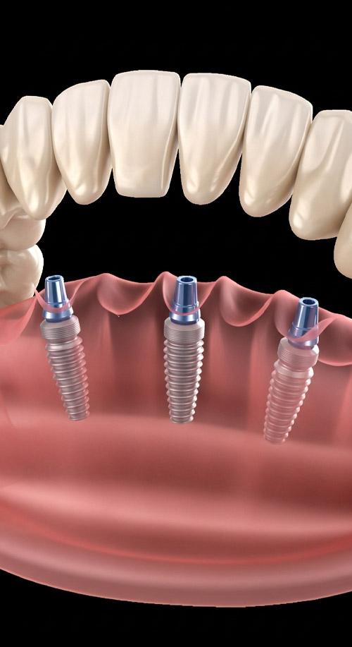 All-on-4 method at Dental Vana