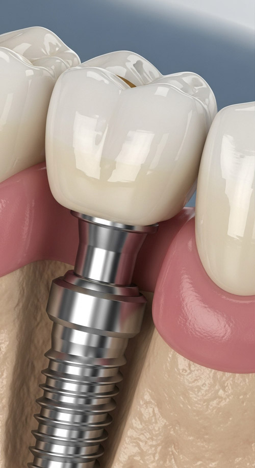 Dental Implants at Dental Vana