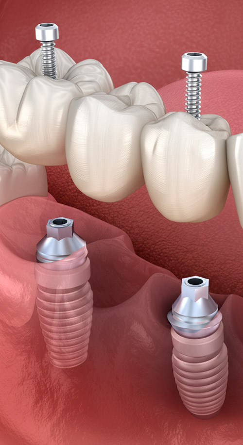 Implants Supported Bridges at Dental Vana