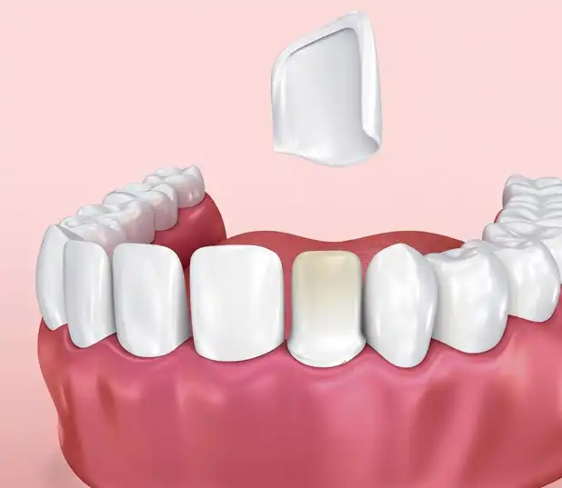 Composite Veneers