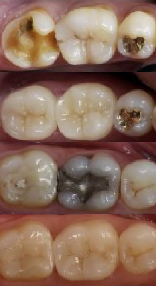 Inlays, Onlays on Dental Vana